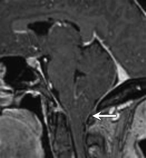 Incidence of Cerebellar Tonsillar Ectopia in Idiopathic Intracranial Hypertension: A Mimic of ...