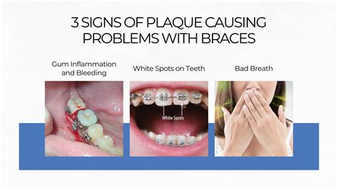 Braces Gums Are Swollen