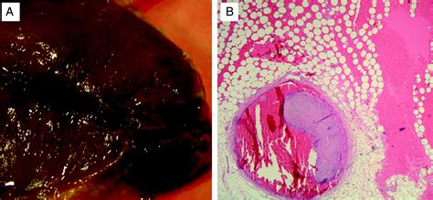 Hemopericardio en infarto agudo de miocardio fibrinolisado secundario a disección coronaria ...