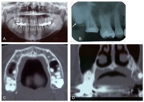 Coronal Cementum and Reduced Enamel Epithelium on Occlusal Surface of ...