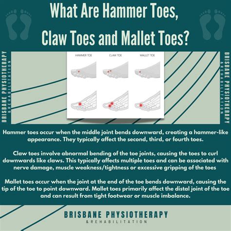 What Are Hammer Toes, Claw Toes, and Mallet Toes - Brisbane Physiotherapy & Podiatry