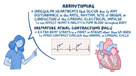 Premature Atrial Contractions Vs Premature Ventricular Contractions