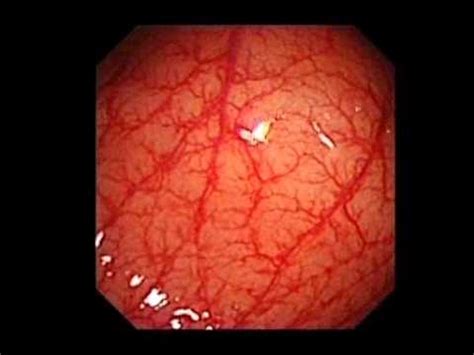 Image result for Colonoscopy Looping