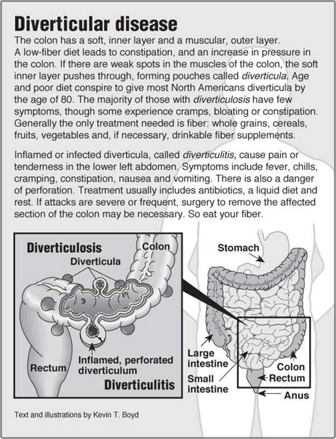 diverticulitis flare up