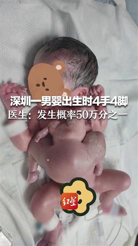 深圳一男婴出生时4手4脚 医生：发生概率50万分之一_凤凰网视频_凤凰网