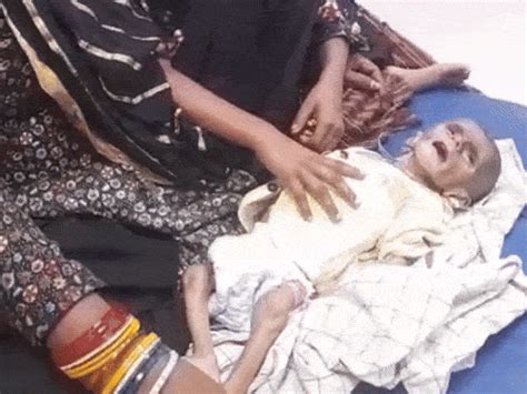 Severely malnourished infant dies due to negligence: 4-month-old ...