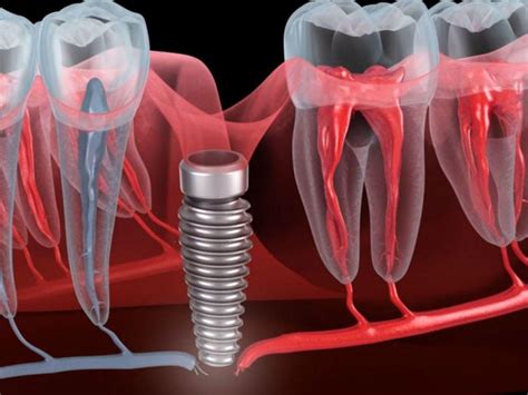 Side Effects of Dental Implants: Common Complications and How to ...