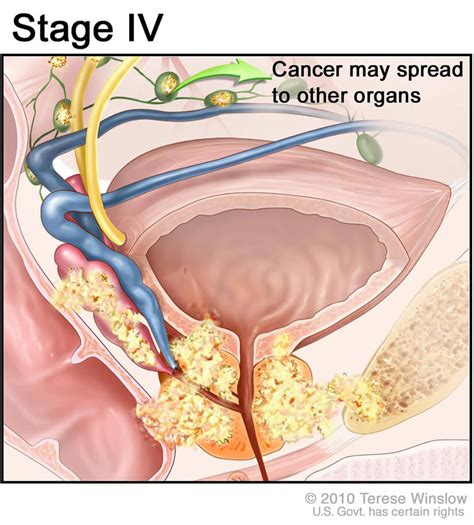 Resultado de imagen de prostate+cancer+stages