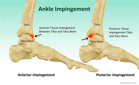 Anterior Ankle Impingement
