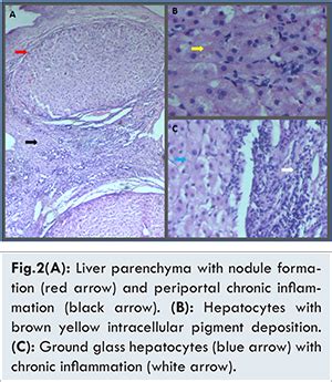 Wilsons Disease Coexisting with Hepatitis A