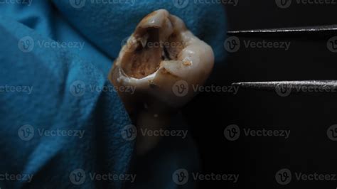 Decayed Tooth Pulling 的图像结果