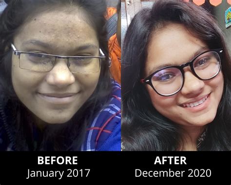 Nitika reverses her 7 year old acne in 1 month – Satvic Movement