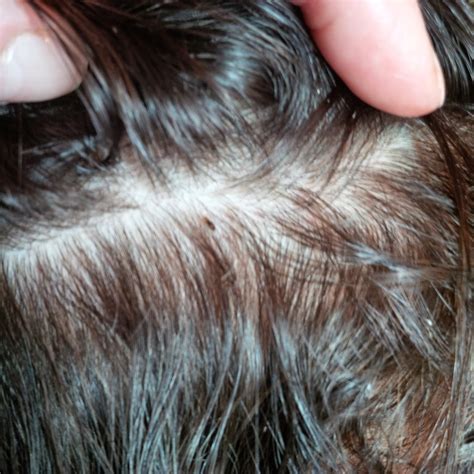 Bed Bug Eggs In Hair
