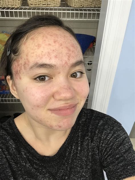 Can I have one drink on accutane ? : r/Accutane