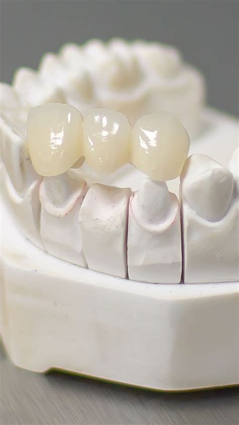 Innovative Solutions in Tooth Restoration: Exploring Dental Bridges | Dental bridge, Dental ...