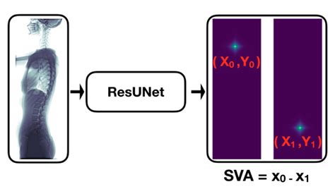 Artificial Intelligence for Automatic Measurement of Sagittal Vertical ...