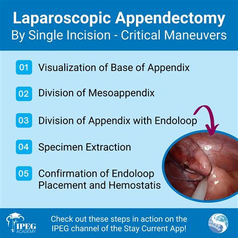 Laparoscopic Appendectomy Video