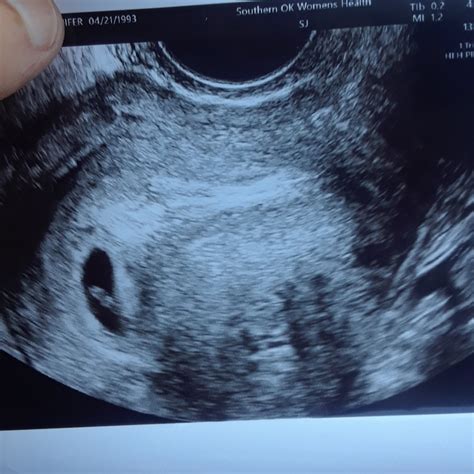 5 Weeks Pregnant With Twins | Twiniversity #1 Parenting Twins Site