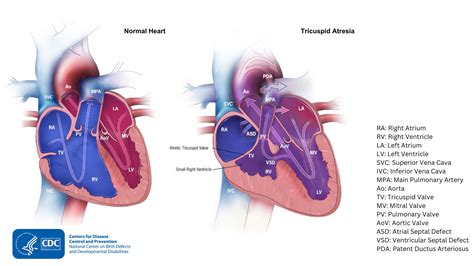 Tricuspid Atresia | Congenital Heart Defects (CHDs) | CDC