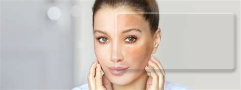Essential Checklist: Identifying Melasma Skin Triggers – World of Asaya