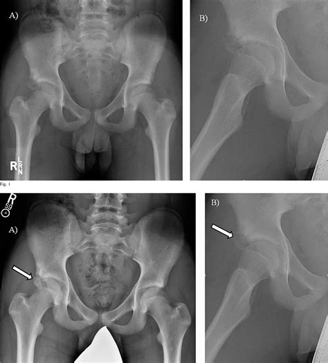 Anterior Inferior Iliac Spine Avulsion