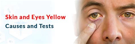 Skin and Eyes Yellow: Causes and Tests | Ganesh Diagnostic