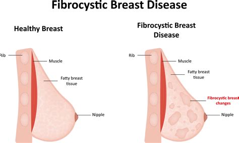 Fibrocystic Breast Disease