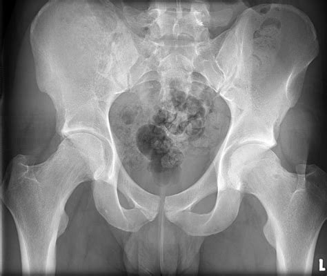 Normal male hip xray - wifility