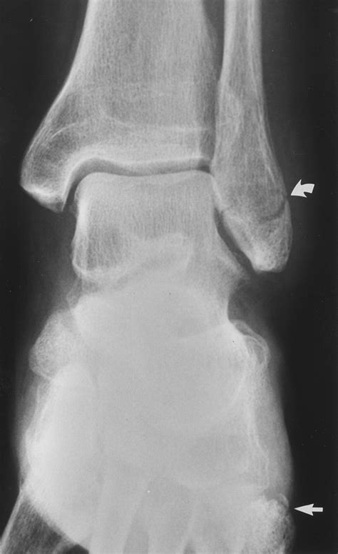 Avulsion Fracture Fibula
