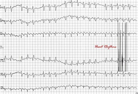 Typical atrial flutter and ecg - Lasidna