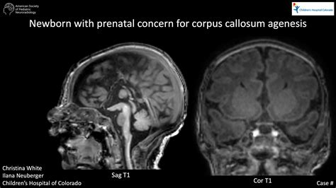 Newborn with prenatal concern for corpus callosum agenesis | American ...