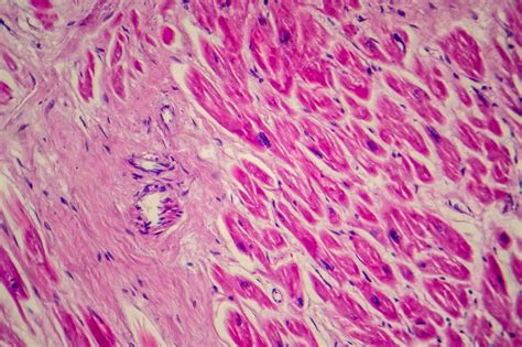 La terapia con células madre tras un infarto