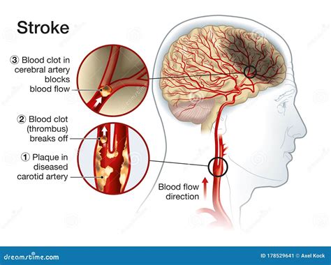 What Can A Blood Clot In The Brain Do at Sybil Downing blog