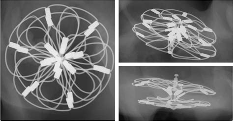 Performance, safety, and biocompatibility of a novel PFO closure device in a long-term porcine ...