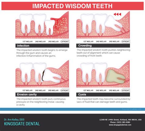 How Do You Know If Your Wisdom Teeth Are Growing In - howsolut