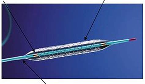'Drug eluting stents should be priced higher'