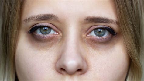 All Your Answers On How To Fix Sunken Eyes | Lumière Clinic