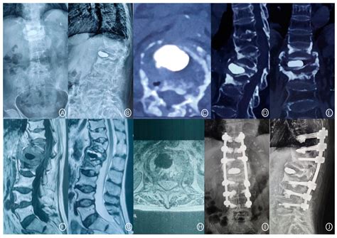 Predictive Factors for Bone Cement Displacement following Percutaneous ...