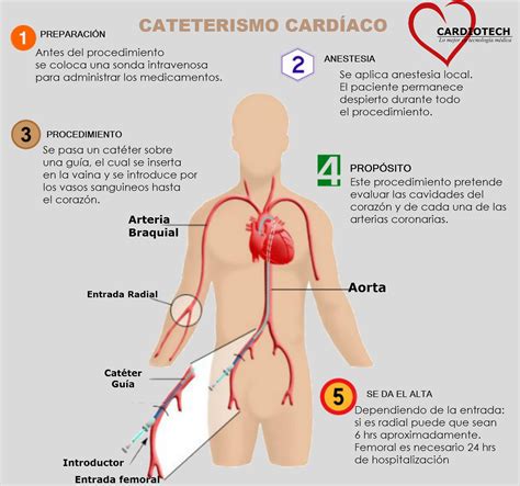 5 pasos para un cateterismo diagnóstico - Cardiotech