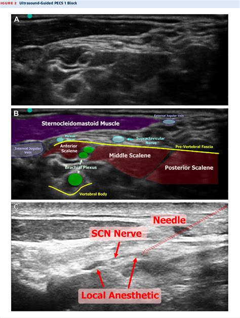 Figure 2 from A Novel Nerve Block Technique for a Patient Undergoing ...