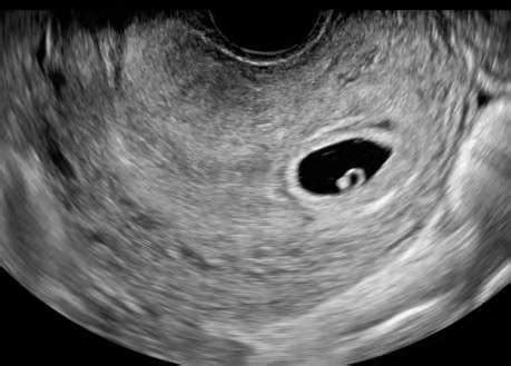 怀孕5周了没看见孕囊是怎么回事？这3个原因提前了解，好放心_检查