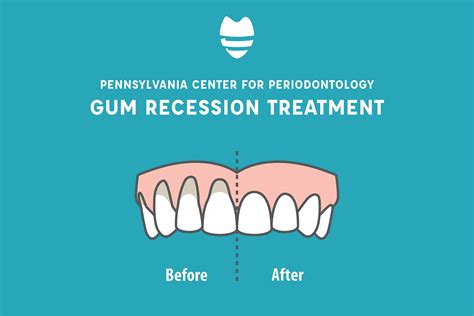 Treatment of Gum Recession - Periodontist in Enola & Camp Hill Area