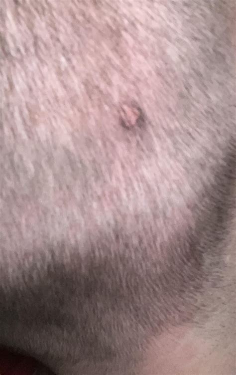 Weird lump on back of head : r/DermatologyQuestions