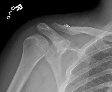 Image result for AC Step Defect