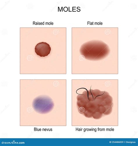 Nevus or Mole Types. Check Nevus Stock Vector - Illustration of ...