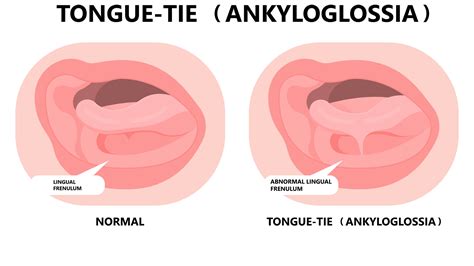 Adults Tongue Tie
