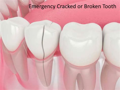 Image result for Broken Toothpick