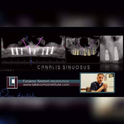 Products tagged with 'sinus lift'-One Dental is the Biggest online ...