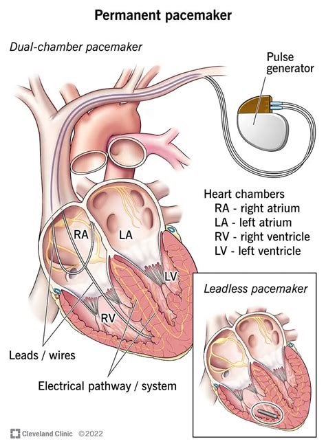 Pacemaker Procedure 的图像结果