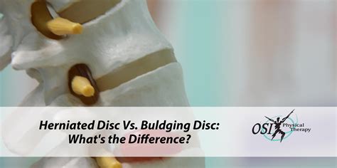 Bulging Disc Vs Herniated Disc The Differences You